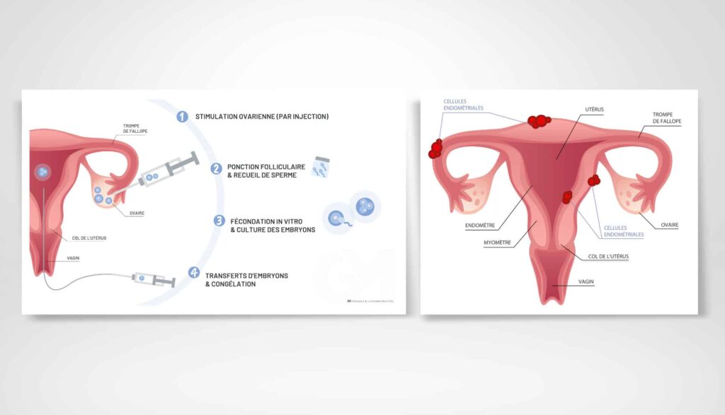 infographie et illustration médicale de l'endométriose et la PMA