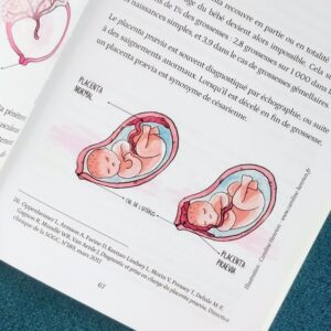Illustration de l'emplacement d'un placenta dans l'utérus