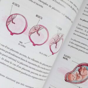 Illustration à l'aquarelle de l'emplacement d'un placenta dans l'utérus