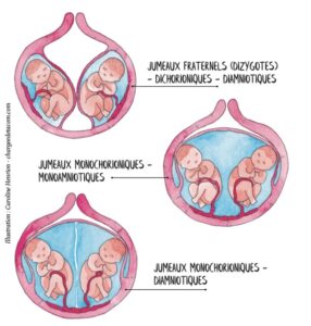 Illustration aquarelle des placentas lors d'une grossesse gémellaire 